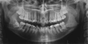 Control a los 10 meses postexodoncia del tercer molar y enucleación de la lesión más curetaje óseo.