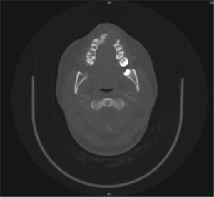 Corte axial de tomografía computarizada en la que se puede apreciar la lesión y la destrucción causada en el maxilar por ella.
