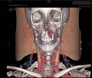 Reconstrucción coronal tridimensional a partir de la tomografía computarizada previa.