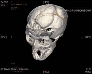 Visión del defecto creado por la lesión a través de una reconstrucción coronal oblicua tridimensional a partir de la tomografía computarizada previa.