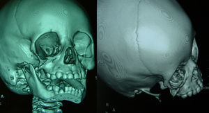 Reconstrucción 3D de la TAC: muestra la destrucción del hueso cigomático en toda su extensión.