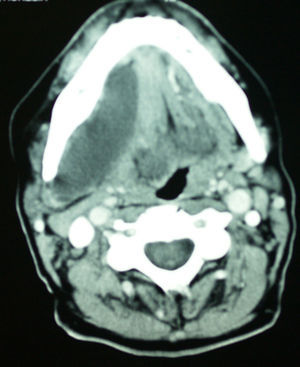 Tomografía computarizada de la lesión con su extensión hacia el suelo de la boca.