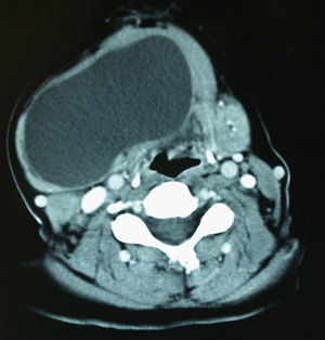 Tomografía computarizada de la lesión con su extensión cervical.