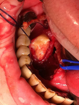 Visión intraoperatoria del suelo de la boca. El conducto de Wharton está separado con un vessel-loop de color azul. La lesión blanquecina se aprecia al fondo.