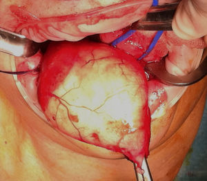 Visión intraoperatoria del suelo de la boca. La lesión evacuada parcialmente cabe por la incisión realizada.