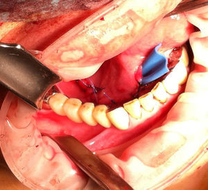 Aspecto del suelo de la boca tras el procedimiento. Se aprecia el drenaje sin aspiración y la sutura con hilo reabsorbibles.