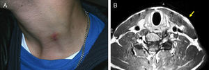 A. Imagen preoperatoria de la lesión localizada sobre el tercio medio-inferior del músculo esternocleidomastoideo; se visualiza cicatriz producida por la toma de biopsia en el Hospital Comarcal desde donde nos fue remitido el paciente. B. RNM axial que muestra una lesión de 3×2cm en el margen posterior del tercio inferior del músculo esternocleidomastoideo (flecha).