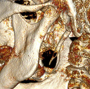 CBCT-3D. Apófisis estiloides izquierda elongada.