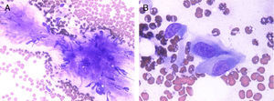 PAAF: A) Población de células fusiformes inmersas en una matriz mixoide (giemsa x100). B) Detalle de fibroblastos con núcleo redondeado de contorno definido y citoplasma pálido (giemsa x400).