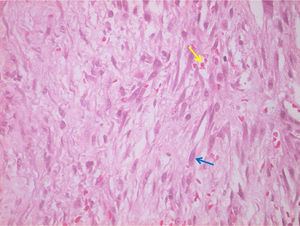 Corte histológico de la lesión (HEx100), donde se observan fibroblastos (flecha azul) incluídos en un estroma edematoso con eritrocitos extravasados (flecha amarilla).