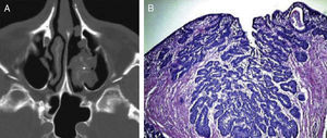 TC de senos paranasales con papiloma invertido maxilar (A) y aspecto microscópico de papiloma invertido con densa hipercelularidad de la superficie epitelial e invaginaciones crípticas dentro del estroma subyacente (B).