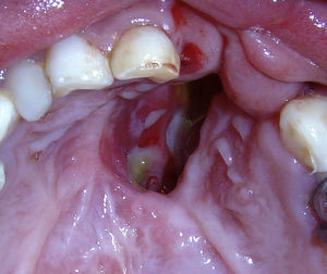 Fístula oronasal de aproximadamente 12mm x 25mm en el tercio anterior del paladar duro. Obsérvese la irritación de la mucosa nasal.