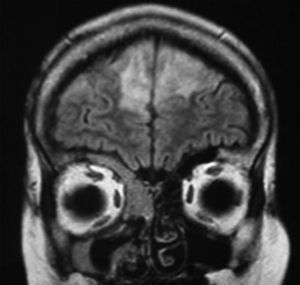 Afectación cerebral en la RMN.