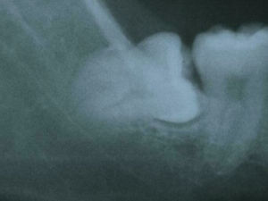 On plane film radiography the apex of the third molar appears very close to the mandibular canal.