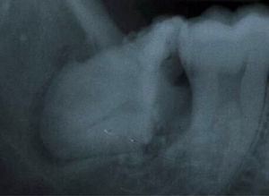 The molar has been moved away from the mandibular canal and can be easily extracted.
