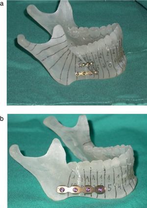 Prototipo mandibular de resina epoxi. a: Fijación con placas 2.0. b: Fijación con placa «lock».