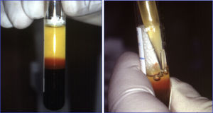 Pipeteado de la fracción correspondiente al plasma rico en plaquetas.