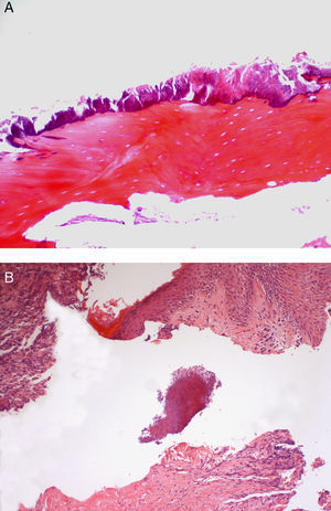 A. Fragmento biópsico óseo, obtenido en una OMBR, en el que se aprecia una colonización por colonias basofilicas filamentosas de Actinomyces israelii cubriendo el frente de necrosis ósea (H&E, 200x). B. Colonia de Actinomyces israelii detectada en la luz de un trayecto fistuloso cutáneo en paciente afecto de OMBR (H&E, 200x).