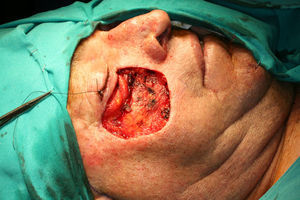 Imagen de la resección de la lesión con márgenes de 1cm.