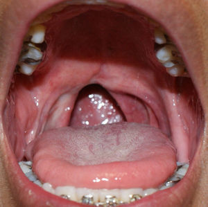 imagen clínica de linfoma no Hodgkin, perdida de úvula y fondo necrótico, que aparece como un defecto eritematoso desde velo de paladar, extendido hasta orofaringe.