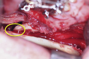 Contacto posterior derecho que lateraliza el fragmento proximal mandibular.