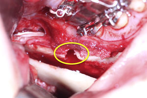 Osteotomía del fragmento distal mandibular.