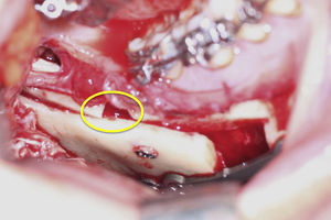 Fijación interna mandibular. Apréciese, el alineamiento más pasivo de los fragmentos mandibulares.