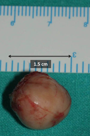 Imagen de pieza quirúrgica mostrando su exéresis completa. Lesión de 1,5cm de diámetro, bien encapsulada y con escasa vascularización.