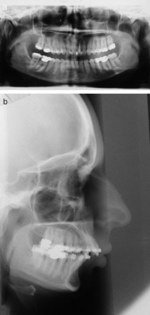 Caso 1: Deformidad dentofacial clase II. Se propone osteotomía mandibular de avance. Radiología preoperatoria: ortopantomografía (1a) y telerradiografía (1b).
