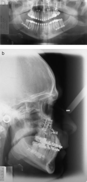 Caso 3. Radiografías post-operatorias inmediatas: ortopantomografía (10a) y telerradiografía (10b).