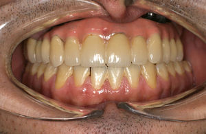 Caso 3: Rehabilitación de las secuelas mediante implantes dentales y prótesis híbrida.
