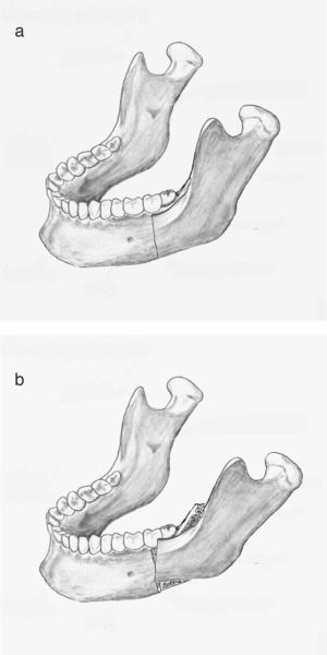 La osteotomía incompleta se produce con frecuencia a nivel del ángulo mandibular (15a). El fragmento proximal rota sobre esta zona de fractura en tallo verde pudiendo pasar desapercibida (15b).