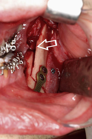 El centrado de la línea media mandibular conlleva problemas para adaptar los fragmentos proximales para la osteosíntesis. Una fractura en tallo verde del ala lingual del fragmento distal favorece la adaptación sin provocar la rotación del cóndilo.