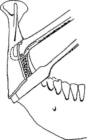 Mommaerts recomienda colocar un escoplo o periostotomo en la osteotomía horizontal para evitar la fractura indeseada. Dibujo publicado de Mommaerts11 y reproducido con la autorización del autor.