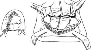 Fractura en paladar en un paciente edéntulo. Dibujo publicado de Li56 y reproducido con la autorización del autor.