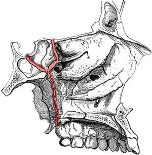 Los trazos verticales ascendentes de fractura del esfenoides son responsables de las complicaciones más graves en cirugía ortognática. Imagen redibujada de la referencia bibliográfica 21.