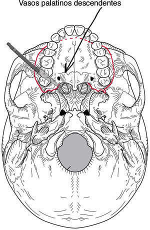 En la osteotomía de LeFort pueden dañarse los vasos palatinos descendentes. Imagen redibujada de la referencia bibliográfica 21.