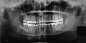 Caso 1: Radiología postoperatoria (ortopantomografía).