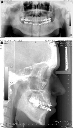 Caso 2: Deformidad dentofacial clase III asimétrica. Se propone osteotomía maxilar de avance y mandibular de centrado y retrusión. Radiología preoperatoria: ortopantomografía (5a) y telerradiografía (5b).