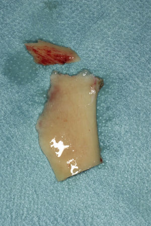 Caso 2: Extensa fractura del ala vestibular del fragmento proximal.