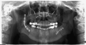 Caso 2: Radiología postoperatoria (ortopantomografía).