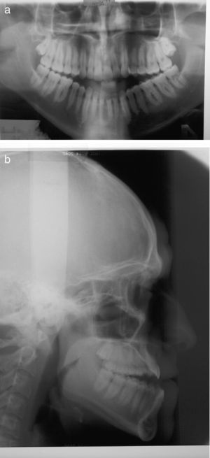 Caso 3. Deformidad dentofacial clase III con mordida abierta anterior. Se propone para cirugía bimaxilar mediante osteotomía maxilar de avance e intrusión posterior y ostetomía mandibular sagital de retrusión. Ortopantomografía (9a) y Telerradiografía (9b).