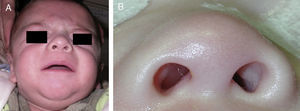 A: imagen preoperatoria. B: detalle de la protrusión tumoral transnasal.