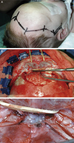 Imagen intraoperatoria. A) diseño de la incisión bicoronal. B) abordaje. C) localización tumoral.