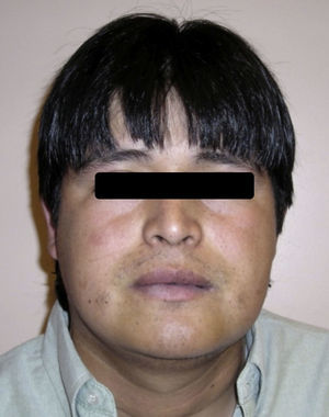 Fotografía extraoral del paciente en la cual puede observarse un aumento de volumen mandibular izquierdo. La piel que cubre la lesión es normal.