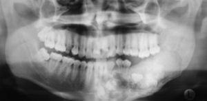Radiografía panorámica. Se observa extensa lesión mixta de predominio radioopaco con límites netos que compromete cuerpo y rama mandibular del lado izquierdo.