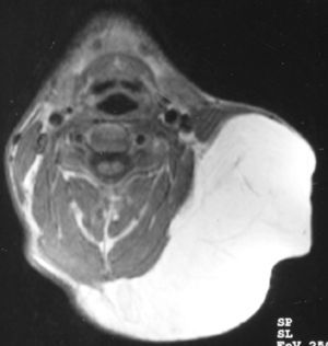 RM preoperatoria (corte axial).