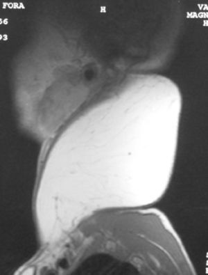 RM preoperatoria (corte sagital).