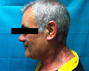 Control clínico al mes.