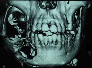 TC diagnóstico de ameloblastoma mandibuar.